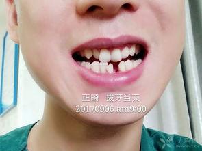 成人怎么正畸牙齿图片视频,图片与视频解析正畸全过程