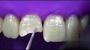 门牙成人补牙视频教程,轻松掌握补牙步骤与技巧