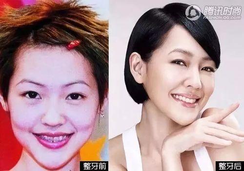 成人牙套测评视频大全集,成人牙套测评视频大全集深度解读